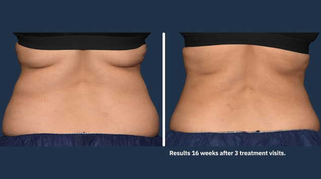 CoolSculpting Elite love handles before & after